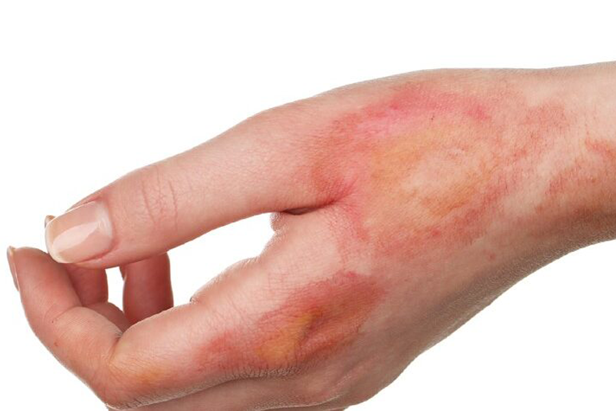 Burn and acid effect